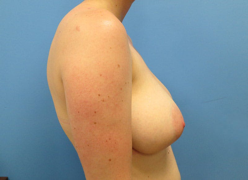 Breast Reduction Before & After Gallery - Patient 112341486 - Image 9