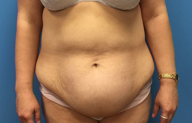 Abdominoplasty Before & After Gallery - Patient 112341487 - Image 1
