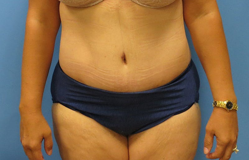 Abdominoplasty Before & After Gallery - Patient 112341487 - Image 2