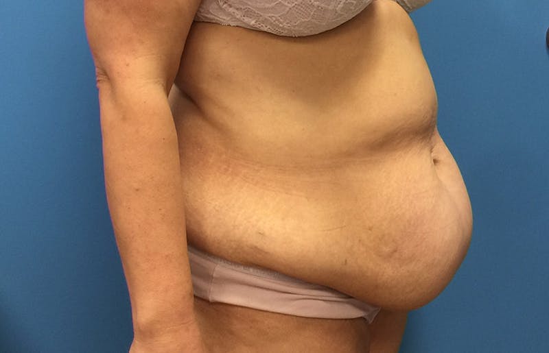 Abdominoplasty Before & After Gallery - Patient 112341487 - Image 3