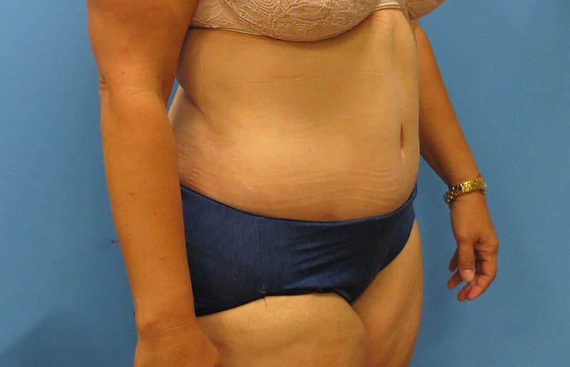 Abdominoplasty Before & After Gallery - Patient 112341487 - Image 4