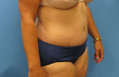 Abdominoplasty Before & After Gallery - Patient 112341487 - Image 4