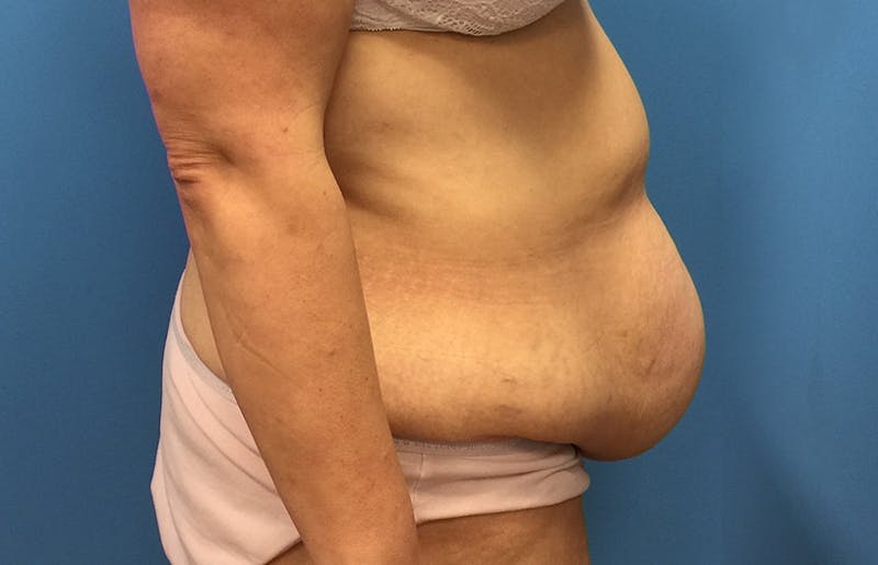 Abdominoplasty Before & After Gallery - Patient 112341487 - Image 5