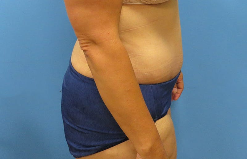 Abdominoplasty Before & After Gallery - Patient 112341487 - Image 6