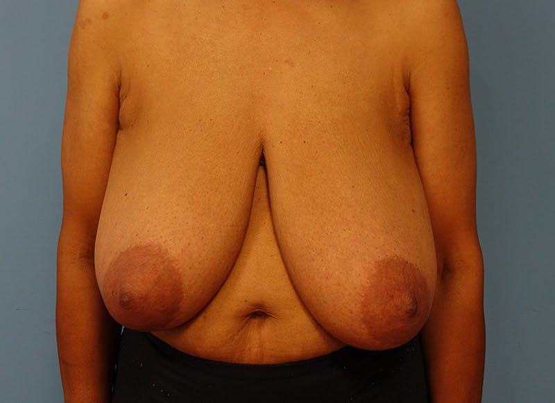 Breast Reduction Before & After Gallery - Patient 112341491 - Image 5