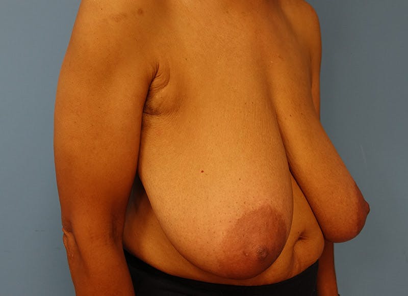 Breast Reduction Before & After Gallery - Patient 112341491 - Image 7