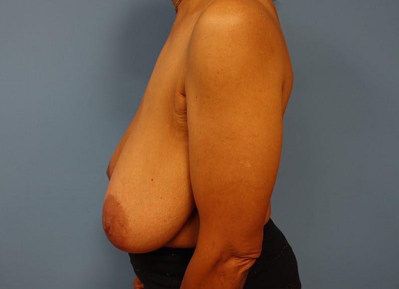 Breast Reduction Before & After Gallery - Patient 112341491 - Image 1