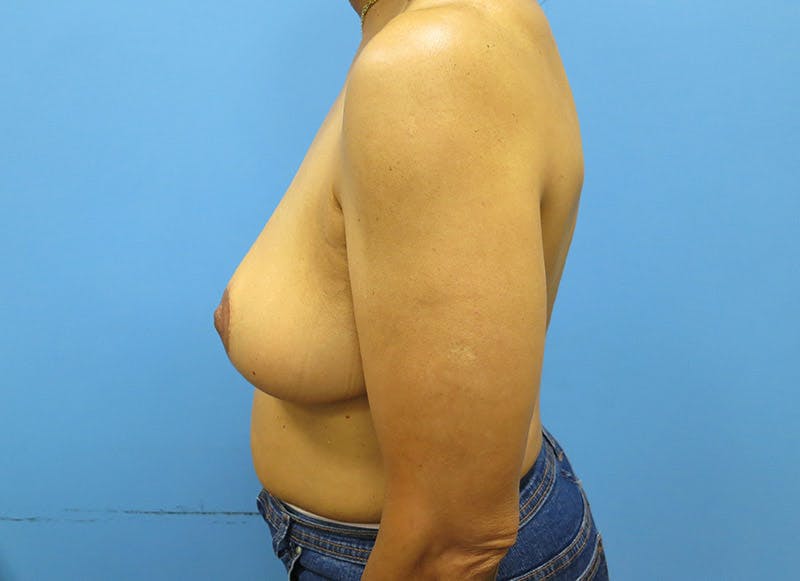 Breast Reduction Before & After Gallery - Patient 112341491 - Image 2