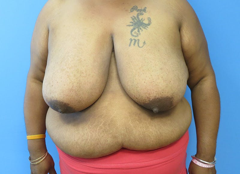 Breast Reduction Before & After Gallery - Patient 112341493 - Image 5