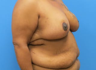 Breast Reduction Before & After Gallery - Patient 112341493 - Image 8