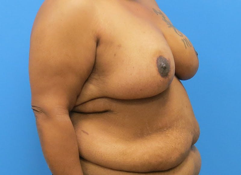 Breast Reduction Before & After Gallery - Patient 112341493 - Image 8
