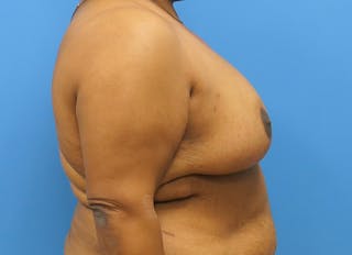 Breast Reduction Before & After Gallery - Patient 112341493 - Image 10