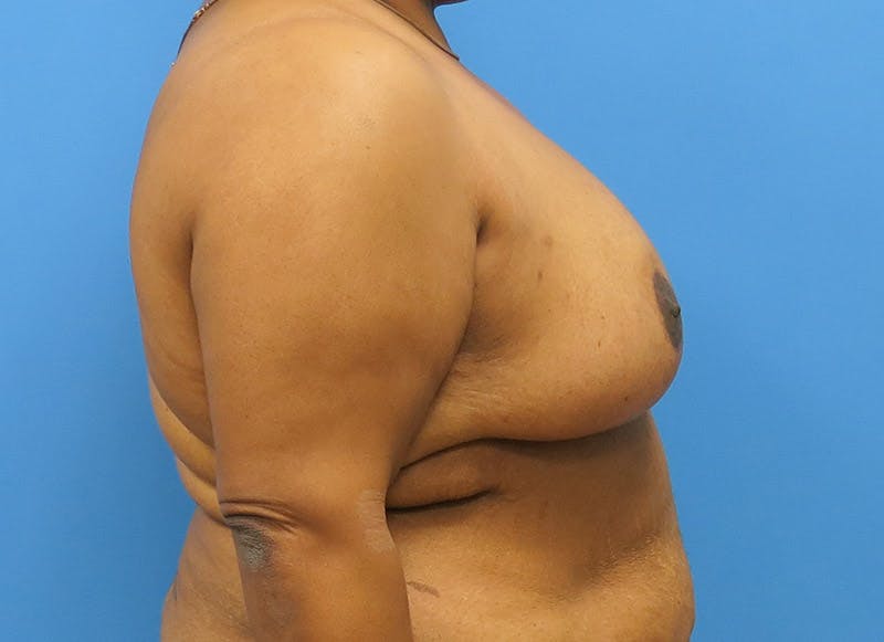 Breast Reduction Before & After Gallery - Patient 112341493 - Image 10