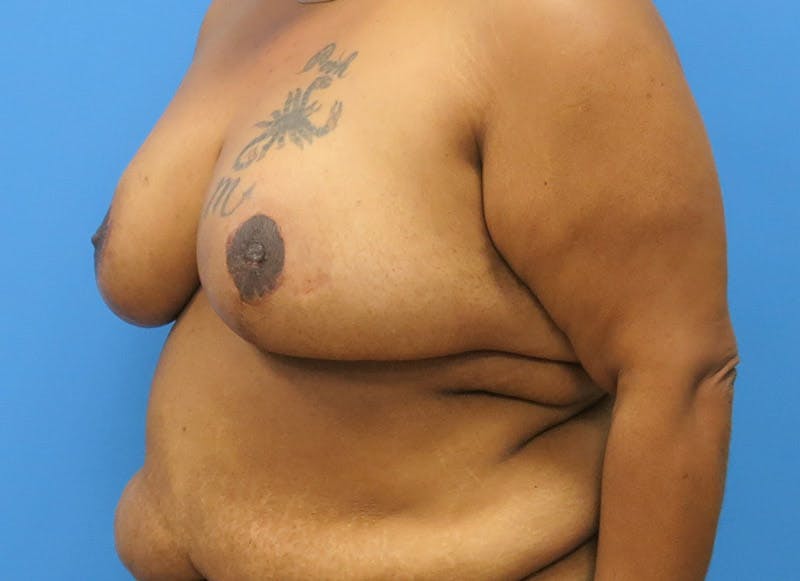 Breast Reduction Before & After Gallery - Patient 112341493 - Image 4