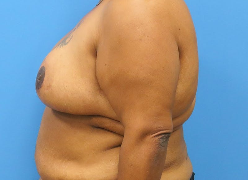 Breast Reduction Before & After Gallery - Patient 112341493 - Image 2