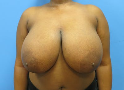 Breast Reduction Before & After Gallery - Patient 112341496 - Image 5