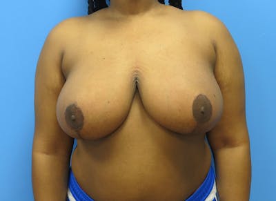 Breast Reduction Before & After Gallery - Patient 112341496 - Image 6