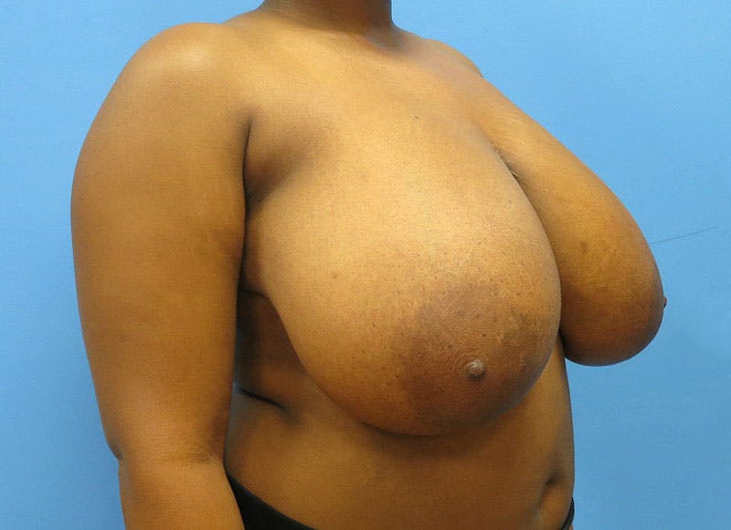 Breast Reduction Before & After Gallery - Patient 112341496 - Image 7