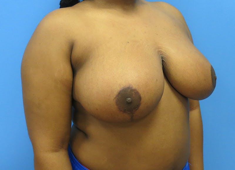 Breast Reduction Before & After Gallery - Patient 112341496 - Image 8
