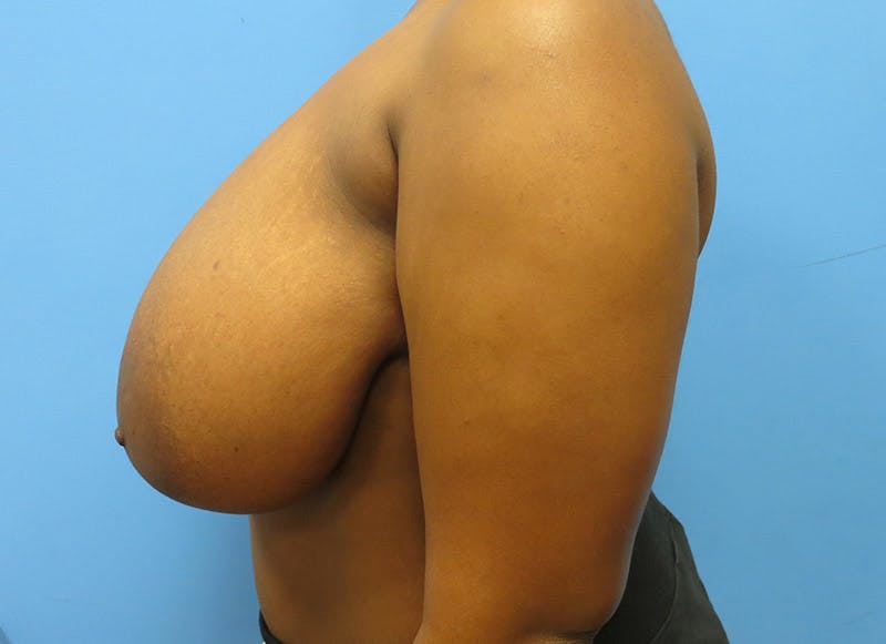 Breast Reduction Before & After Gallery - Patient 112341496 - Image 1