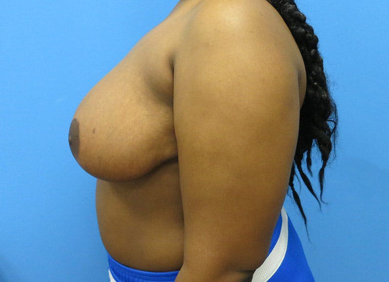 Breast Reduction Before & After Gallery - Patient 112341496 - Image 2