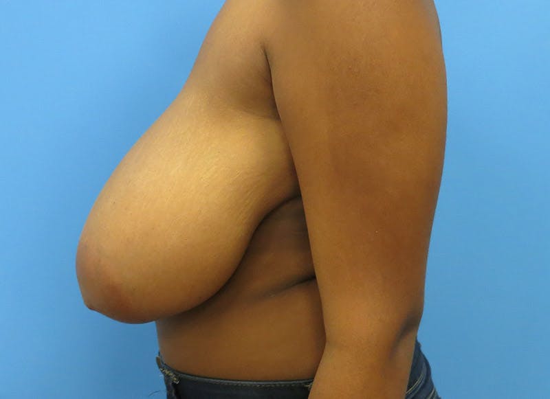 Breast Reduction Before & After Gallery - Patient 112341498 - Image 1