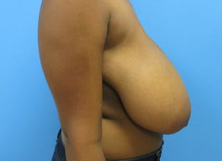 Breast Reduction Before & After Gallery - Patient 112341498 - Image 8