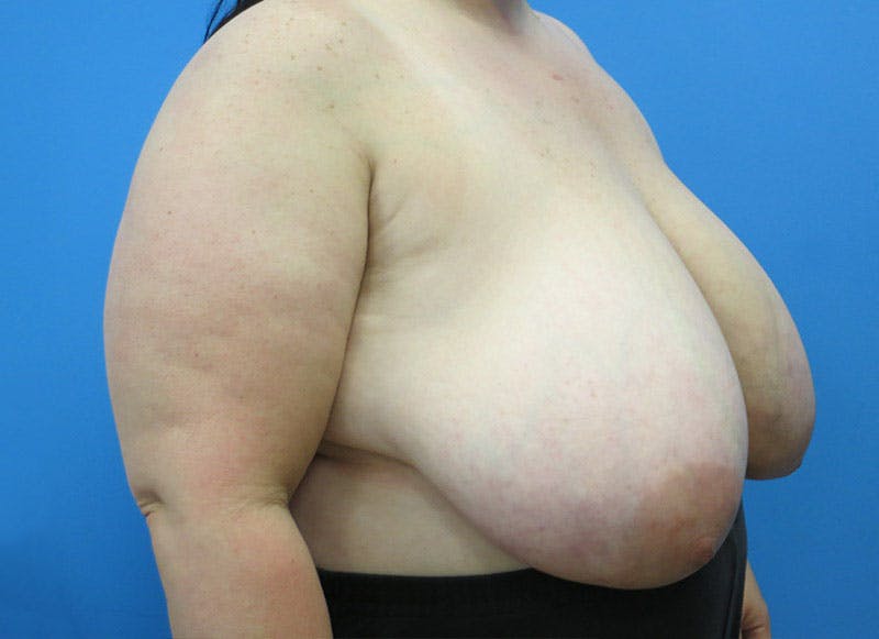 Breast Reduction Before & After Gallery - Patient 112341500 - Image 7