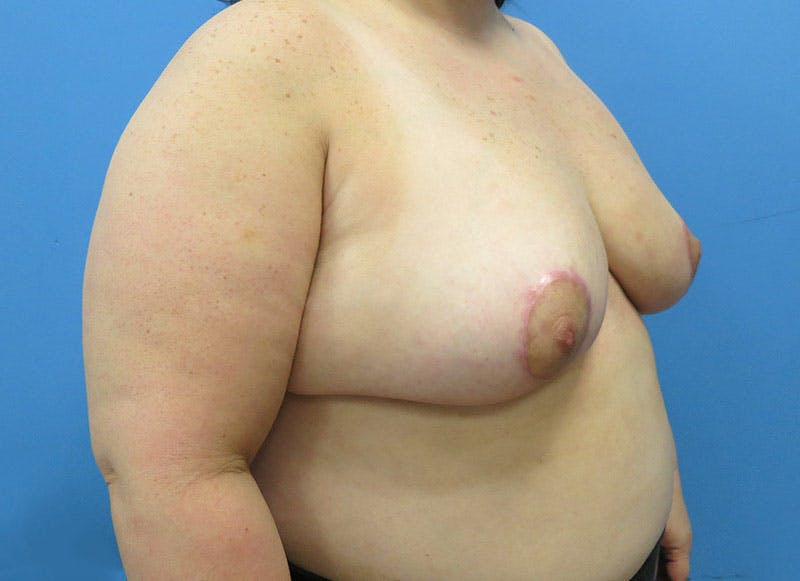 Breast Reduction Before & After Gallery - Patient 112341500 - Image 8