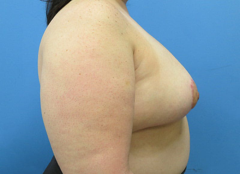 Breast Reduction Before & After Gallery - Patient 112341500 - Image 10