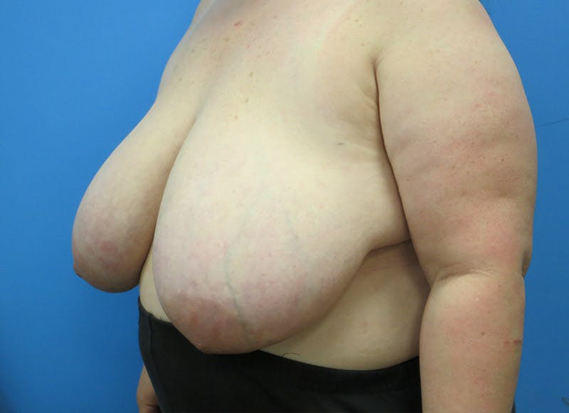 Breast Reduction Before & After Gallery - Patient 112341500 - Image 3