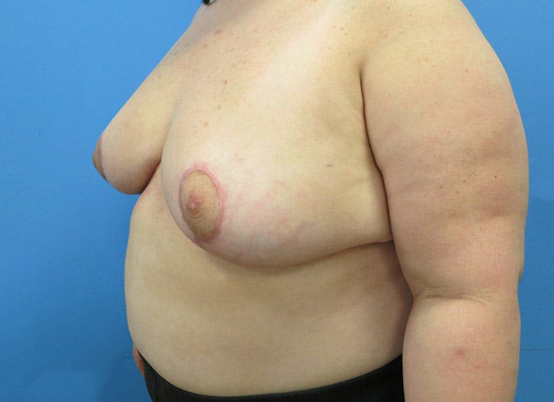 Breast Reduction Before & After Gallery - Patient 112341500 - Image 4
