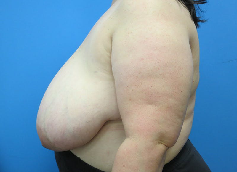 Breast Reduction Before & After Gallery - Patient 112341500 - Image 1