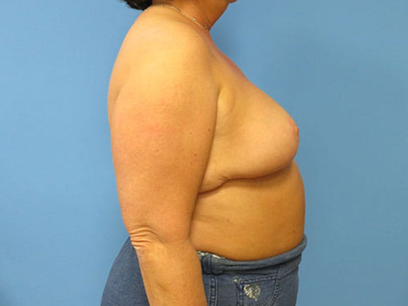 Breast Reduction Before & After Gallery - Patient 112341503 - Image 10