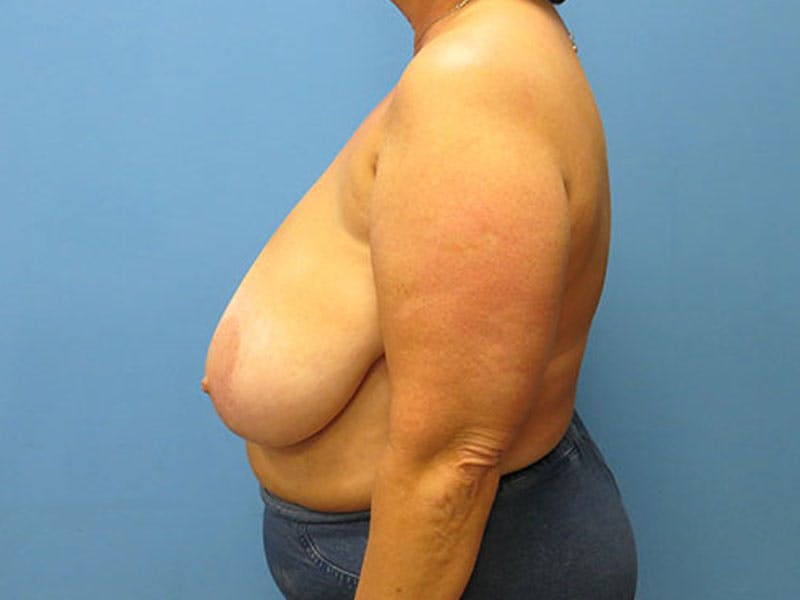 Breast Reduction Before & After Gallery - Patient 112341503 - Image 1