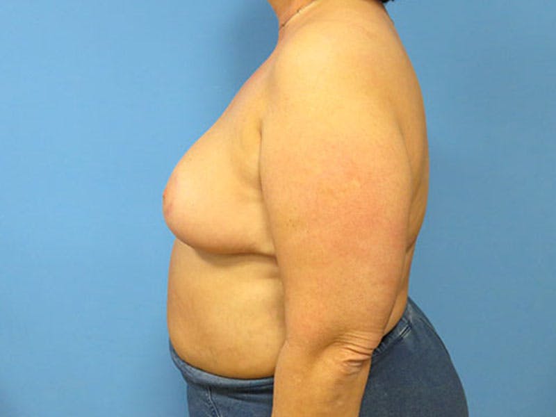 Breast Reduction Before & After Gallery - Patient 112341503 - Image 2