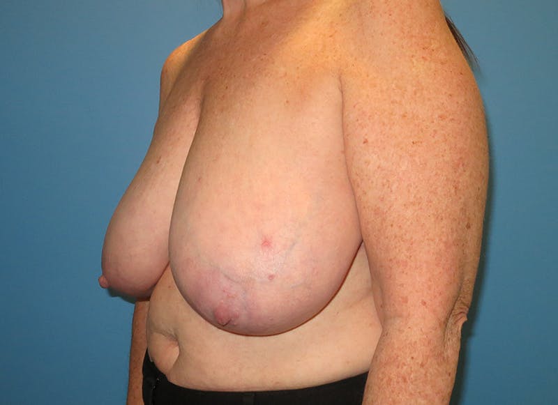 Breast Reduction Before & After Gallery - Patient 112341504 - Image 3
