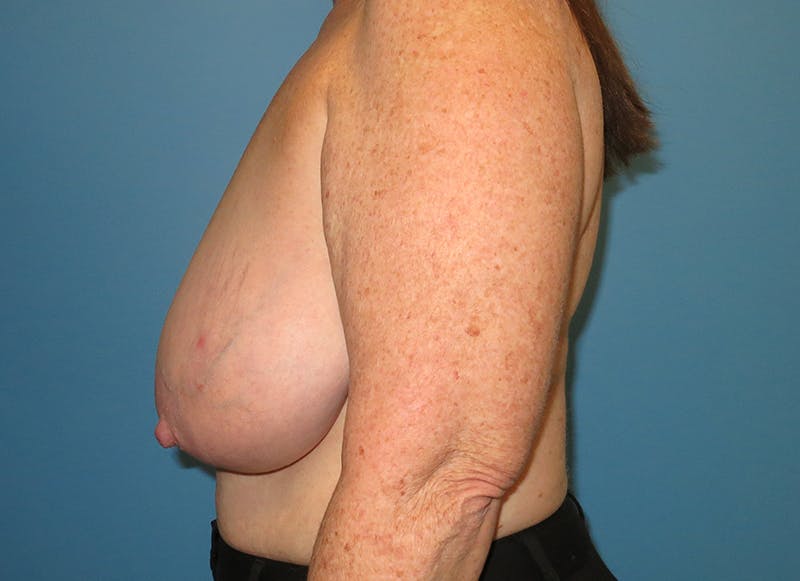 Breast Reduction Before & After Gallery - Patient 112341504 - Image 1