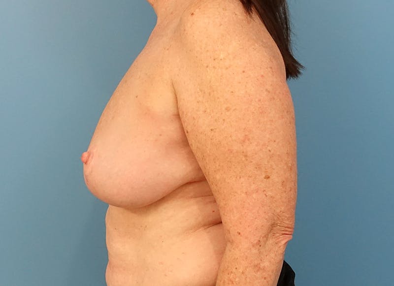 Breast Reduction Before & After Gallery - Patient 112341504 - Image 2