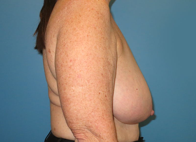 Breast Reduction Before & After Gallery - Patient 112341504 - Image 9