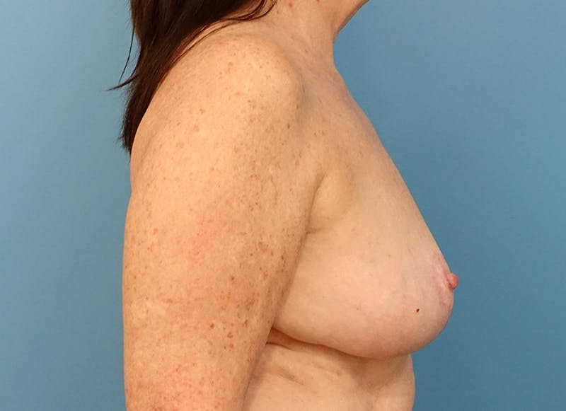 Breast Reduction Before & After Gallery - Patient 112341504 - Image 10