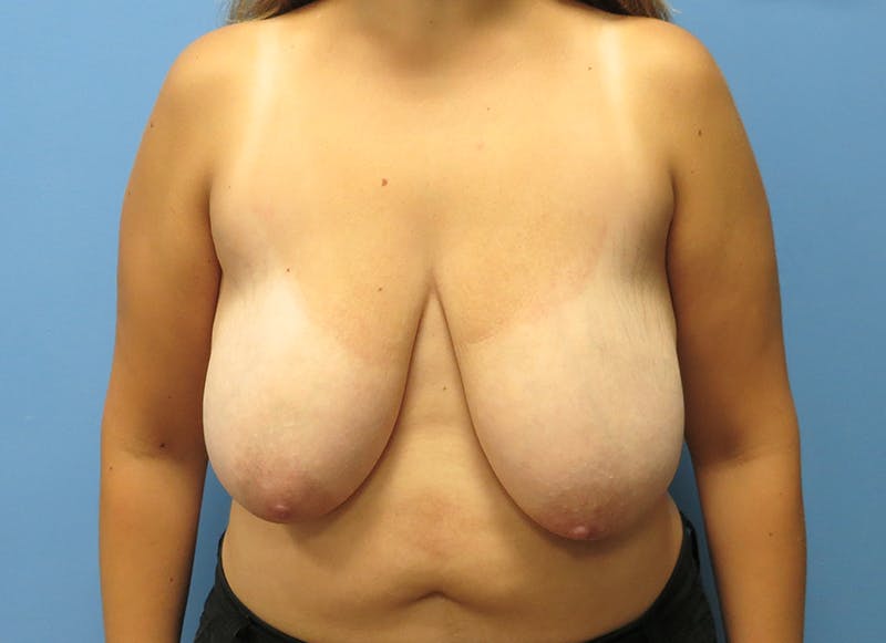 Breast Reduction Before & After Gallery - Patient 112341510 - Image 5