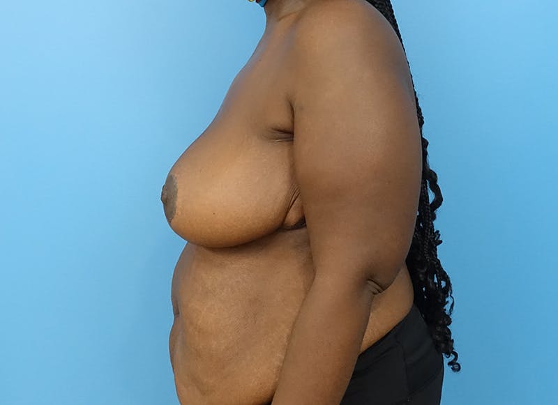 Breast Reduction Before & After Gallery - Patient 112341511 - Image 2