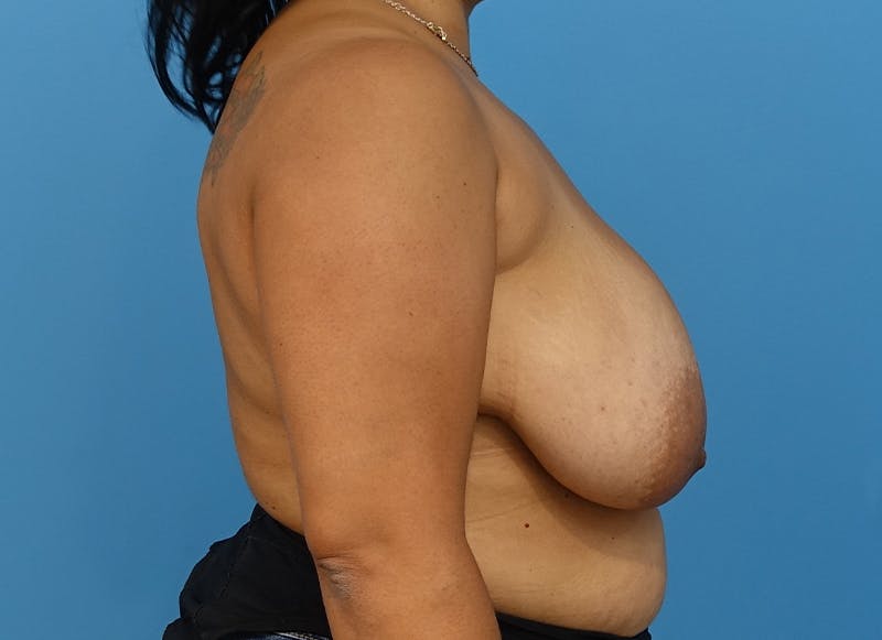 Breast Reduction Before & After Gallery - Patient 112341512 - Image 9