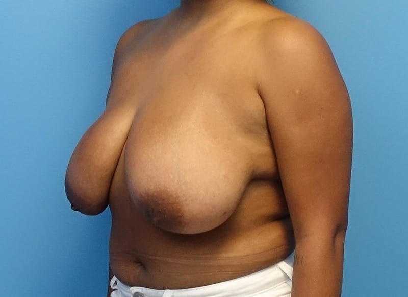 Breast Reduction Before & After Gallery - Patient 112344703 - Image 3