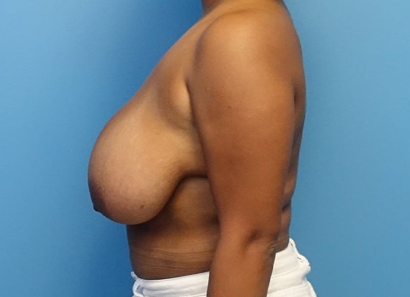 Breast Reduction Before & After Gallery - Patient 112344703 - Image 1