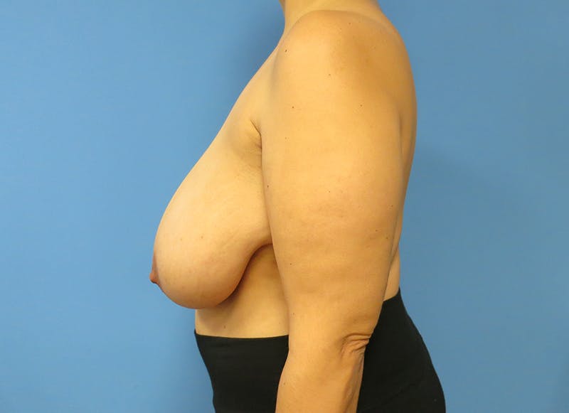 Breast Reduction Before & After Gallery - Patient 112344706 - Image 1