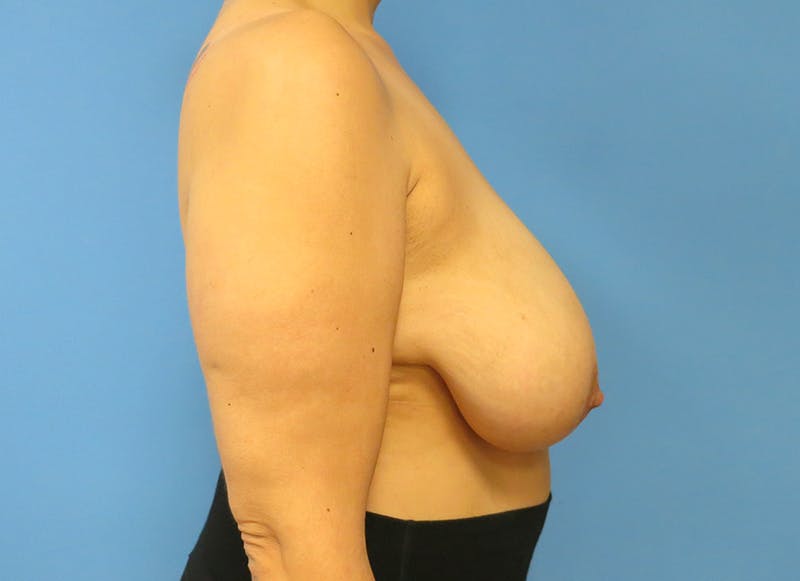 Breast Reduction Before & After Gallery - Patient 112344706 - Image 9
