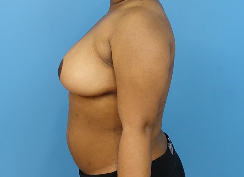 Breast Reduction Before & After Gallery - Patient 112344708 - Image 2