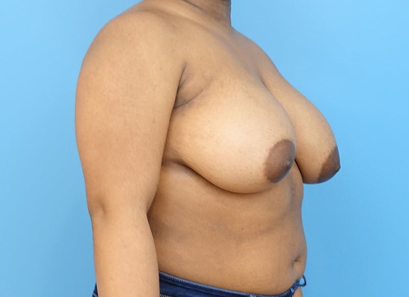 Breast Reduction Before & After Gallery - Patient 112344708 - Image 7